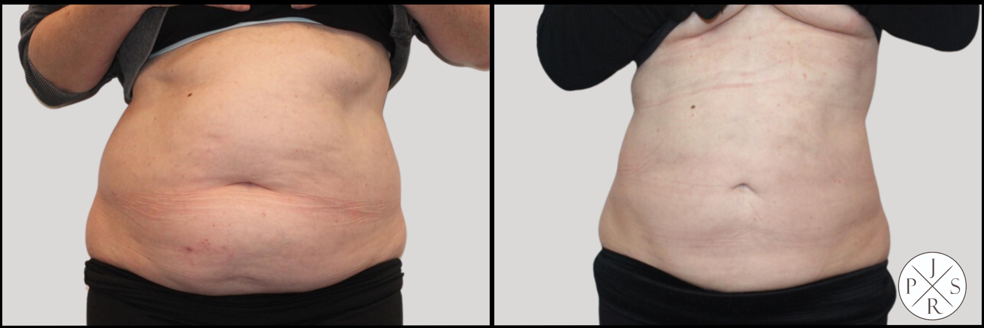 Liposuction Before & After Image